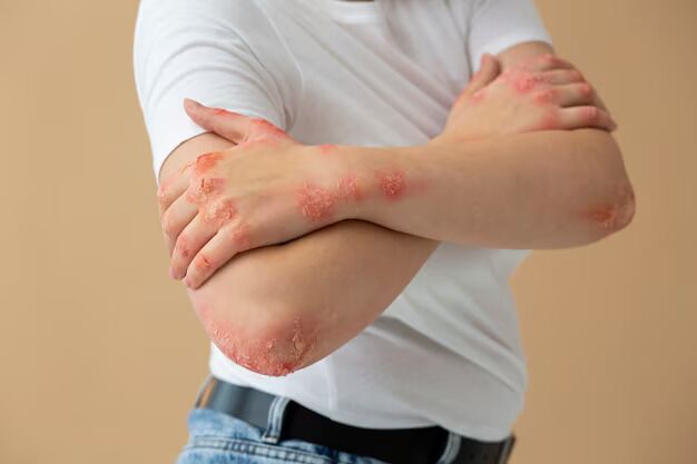 Fungal Diseases